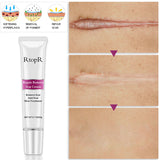 RtopR Acne Scar Stretch Marks Remover Cream Skin Repair Face Cream Acne Spots Acne Treatment Blackhead Whitening Cream Skin Care