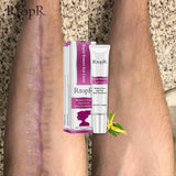 RtopR Acne Scar Stretch Marks Remover Cream Skin Repair Face Cream Acne Spots Acne Treatment Blackhead Whitening Cream Skin Care